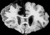 Organizing infarct, middle cerebral artery distribution, with recent hemorrhagic ACA infarct